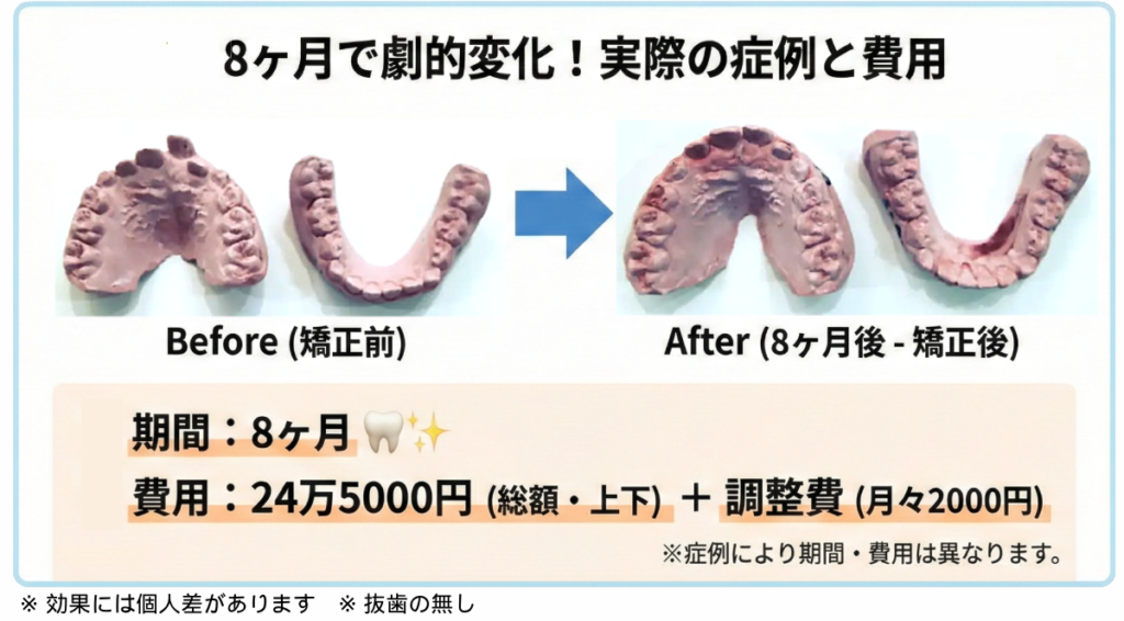 小児矯正の症例写真：板橋区の8歳男児、治療期間8ヶ月での歯並びの変化（ビフォーアフター）